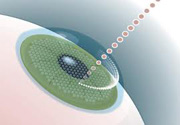 Технология лечения зрения ФЕМТО-ЛАСИК в Германии