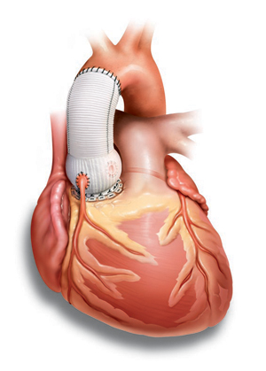 Замена сердечного клапана