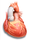Замена сердечного клапана